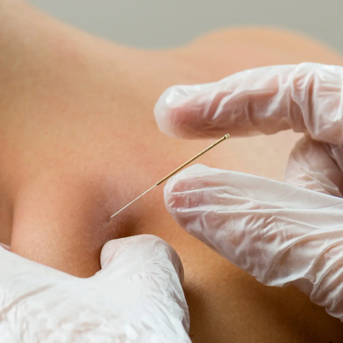 Dry Needling Certified